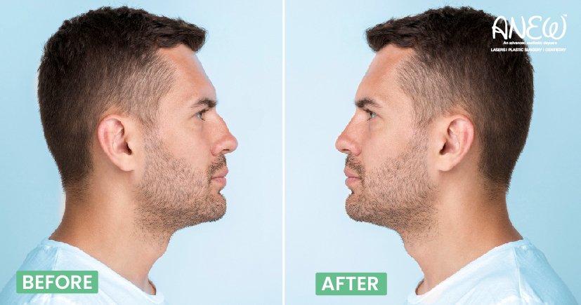 nose plastic surgery in bangalore​ 