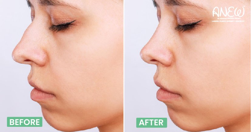 nose plastic surgery in bangalore​ 