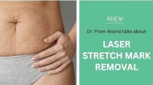 How to Get Rid of Stretch Marks Permanently