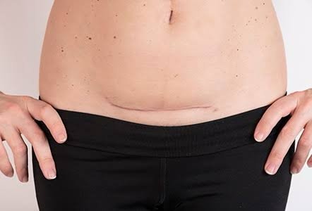 Keloid C-Section Scar Treatment: A Comprehensive Guide
