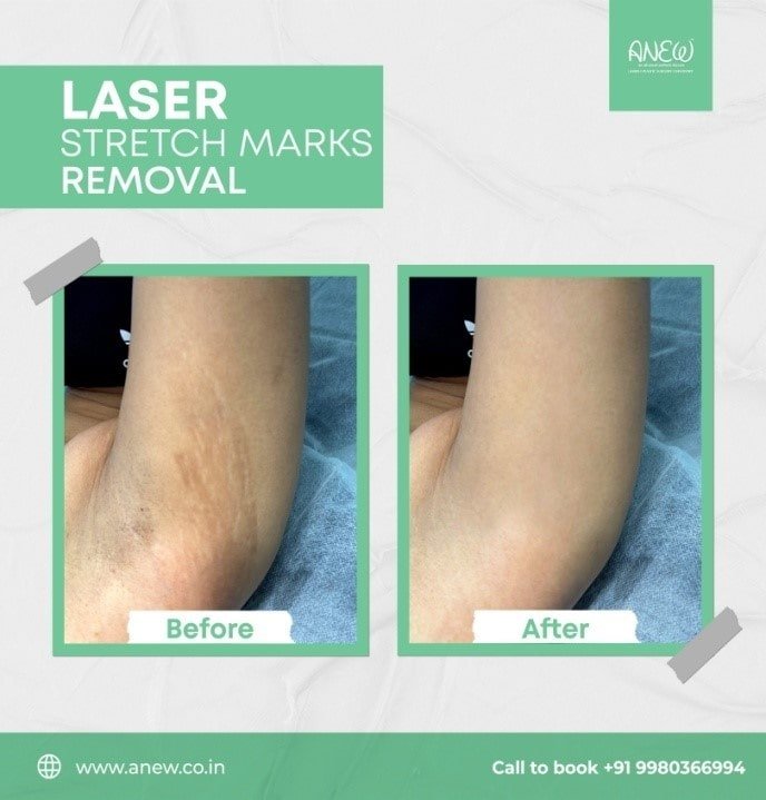 Best Dermatologist for Stretch Mark Treatment in Bangalore