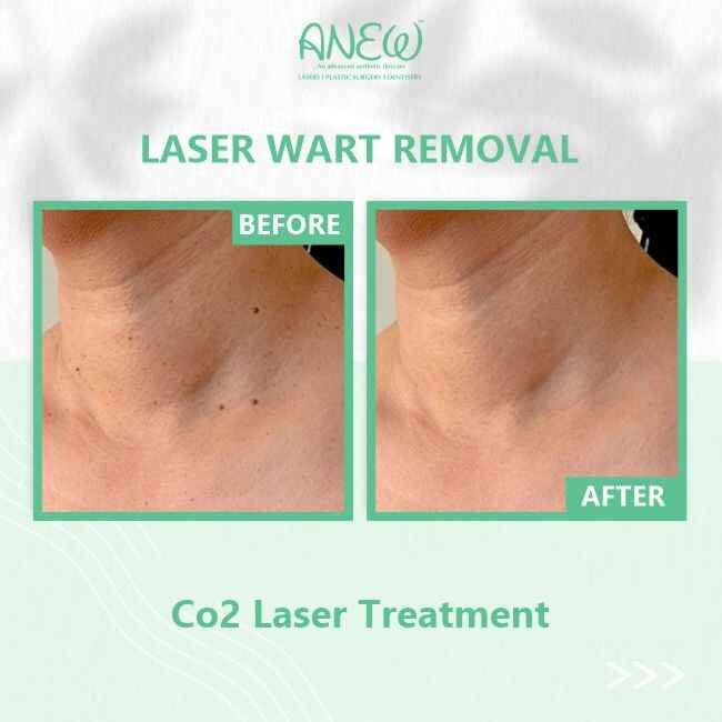 Laser Wart Removal
