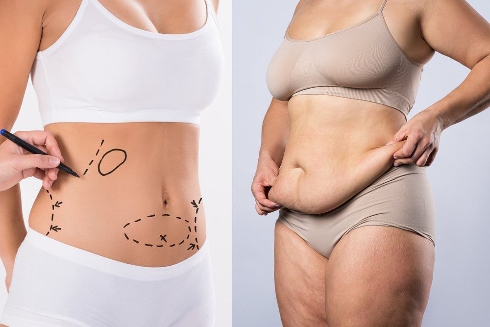 Liposuction vs. Tummy Tuck