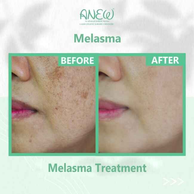 Melasma Treatment in Bangalore