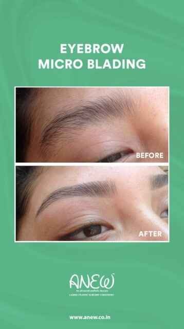 Microblading - Aesthetic Day Care Centre in Bangalore