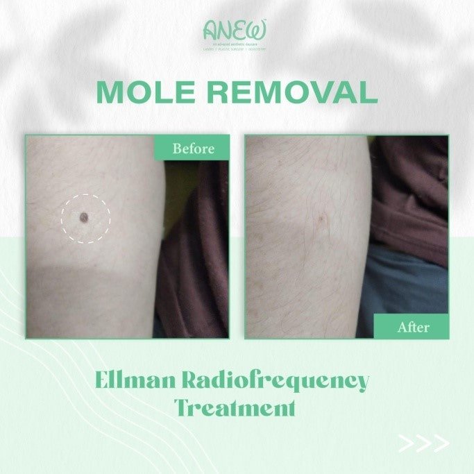 Warts Removal in Bangalore