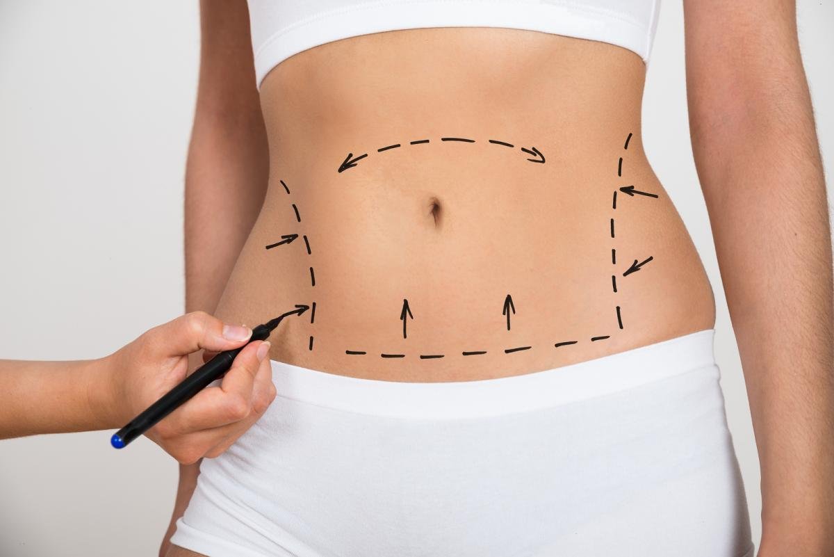 Mummy Makeover Surgery in Banashankari