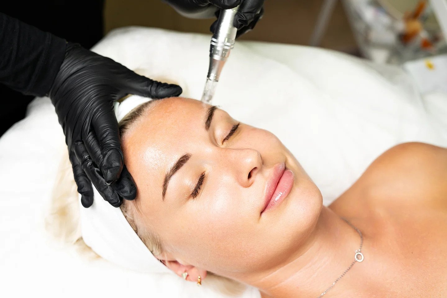 Salmon DNA Microneedling: A Revolutionary Skincare Treatment