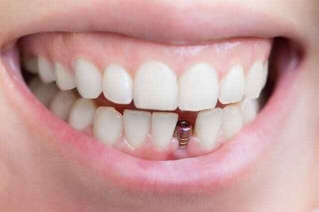 Same Day Dental Implants: Revolutionizing Smile Restoration