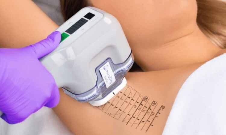 Say Goodbye to Excessive Sweat and Odor with Miradry Treatment at Anew Cosmetic Clinic
