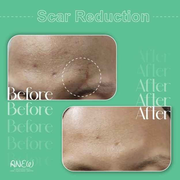 Scar Removal Treatment in Banashankari, Bangalore