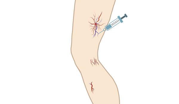Laser Treatment for Varicose Veins in Bangalore