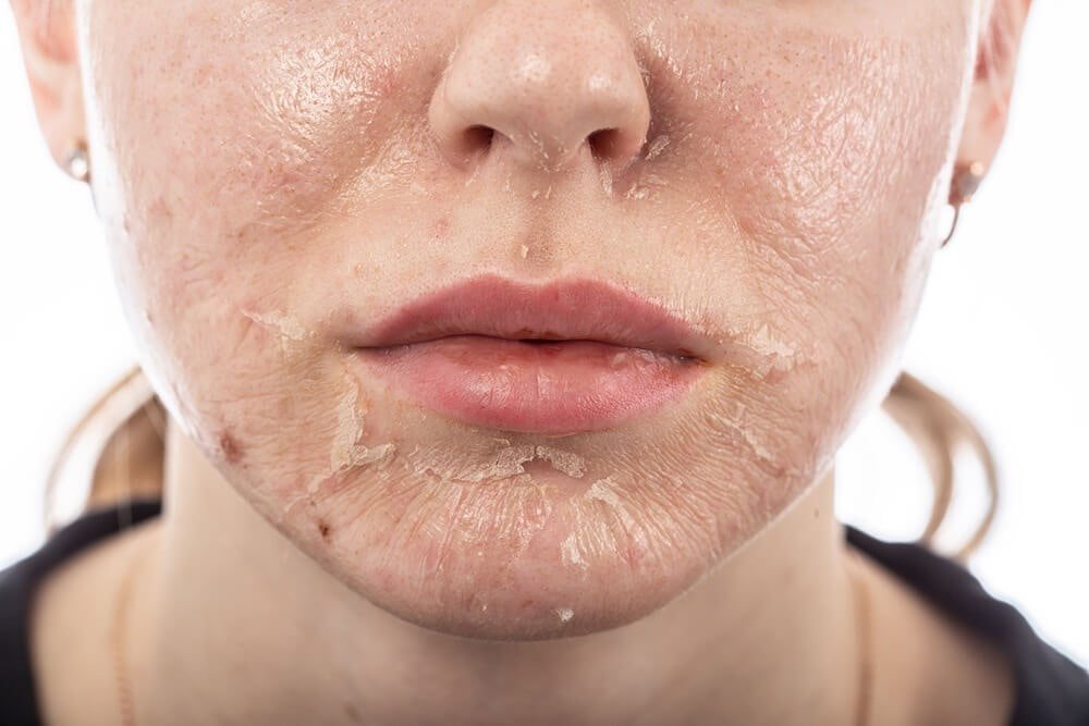 Skincare & Anti-Aging Solutions: Chemical Peels