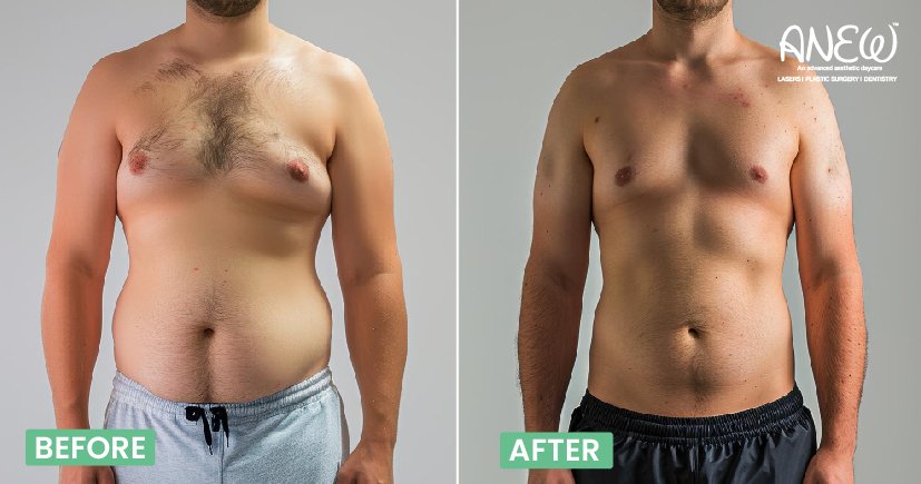Gynecomastia Surgery in Bangalore