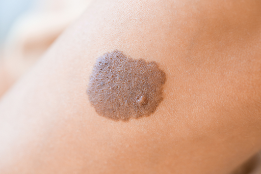 what causes port wine stains