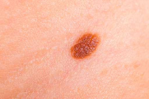 port wine stain causes
