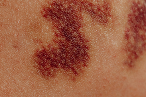 how are port wine stains caused