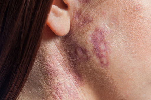 what causes port wine stains