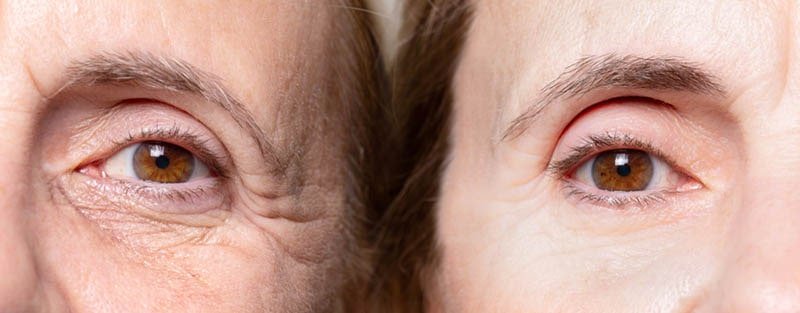 Which is Right for You?  BOTOX V/S Thermage