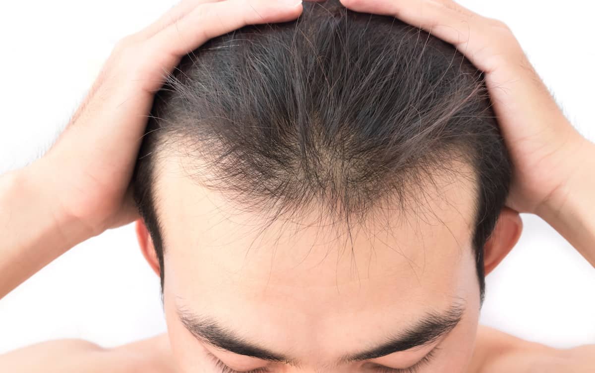Will I Need a Second Hair Transplant?