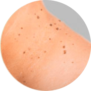 Ellman RF for Warts,Moles &
											Fungal Infections