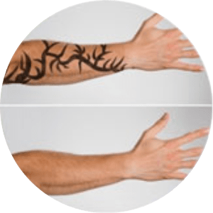 Laser Treatment for Tattoo Removal